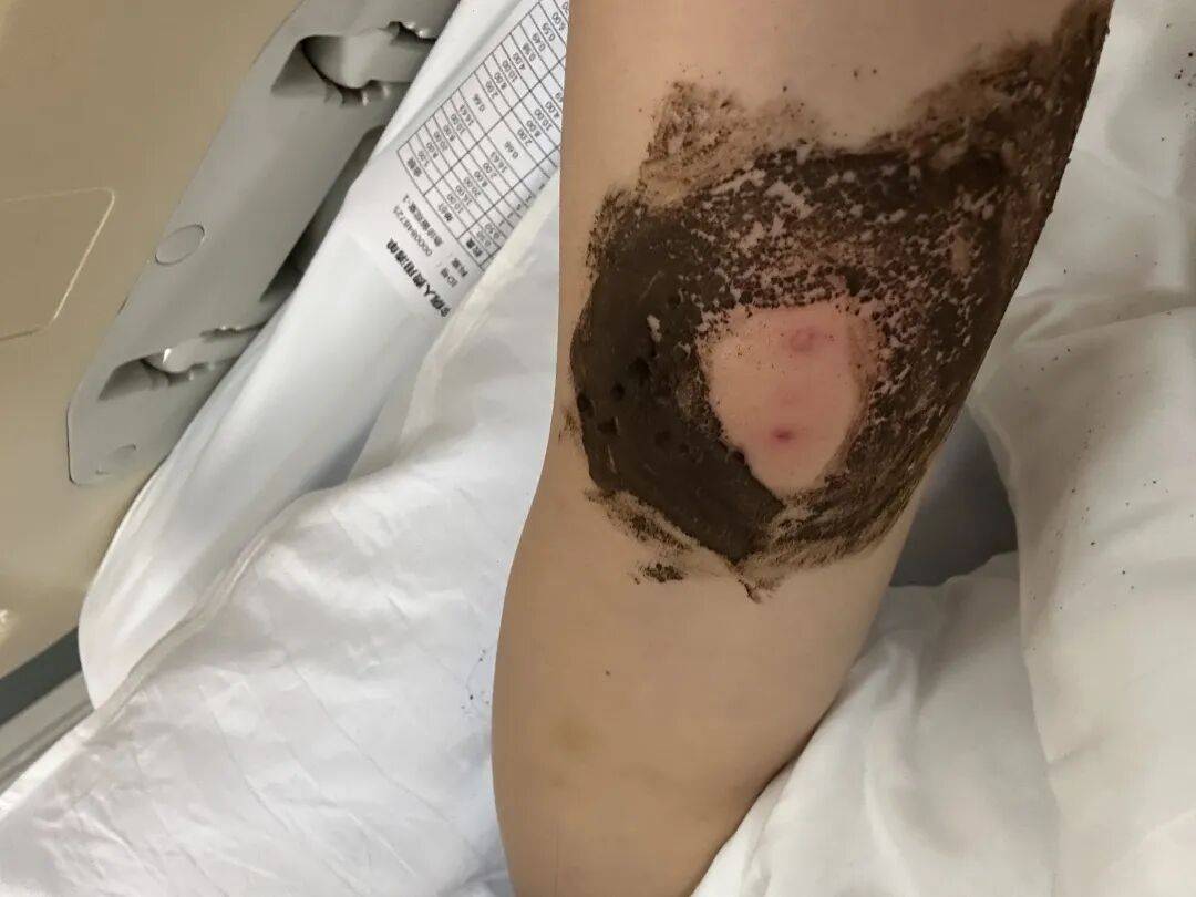 4名游客景区内遭马蜂袭击<strong></p>
<p>币老大</strong>，旅游度假区：是森林公园不卖门票，蜇伤先就医后提供证据投诉