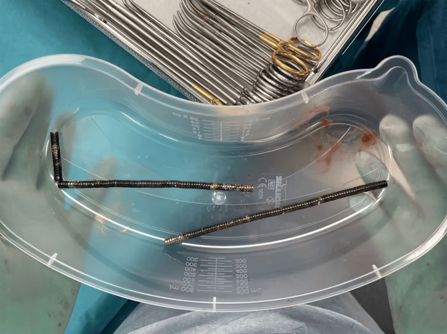 腹痛4天后送医<strong></p>
<p>币优</strong>，新西兰男孩吞下约100颗磁铁致肠道坏死 医生切除部分肠组织